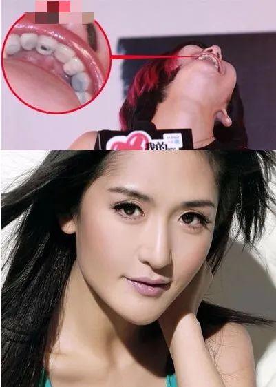 有虫牙的明星,揭秘娱乐圈中的“甜蜜烦恼”